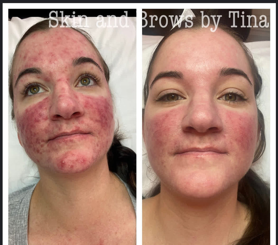 Acne treatment before and after