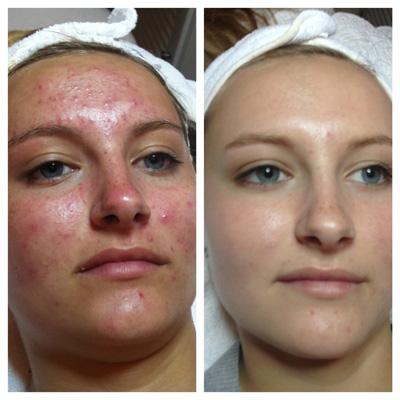 Acne treatment before and after
