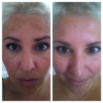 Skin transformation before and after