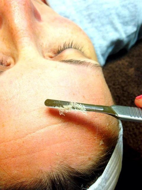 Dermaplaning treatment close-up